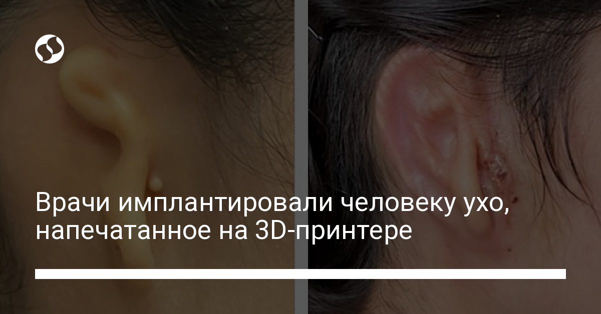 Врачи имплантировали человеку ухо, напечатанное на 3D-принтере - новости Украины,